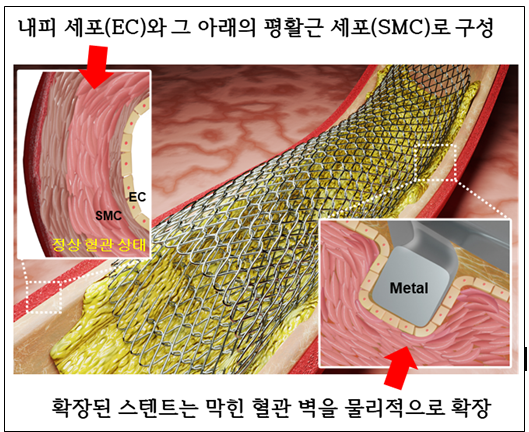 [그림 1] 금속 스텐트가 삽입된 혈관의 모식도